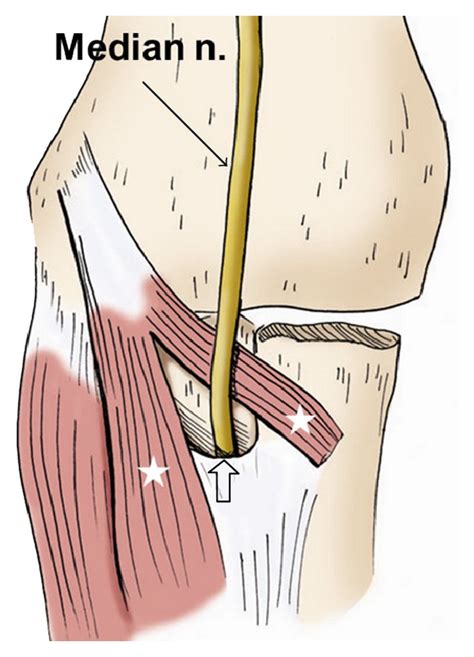 median nerve compression test elbow|median nerve anatomy elbow.